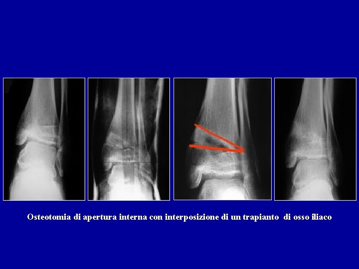 Osteotomia di apertura interna con interposizione di un trapianto di osso iliaco 