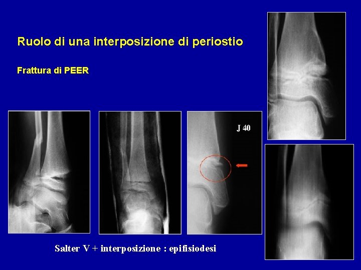 Ruolo di una interposizione di periostio Frattura di PEER Salter V + interposizione :