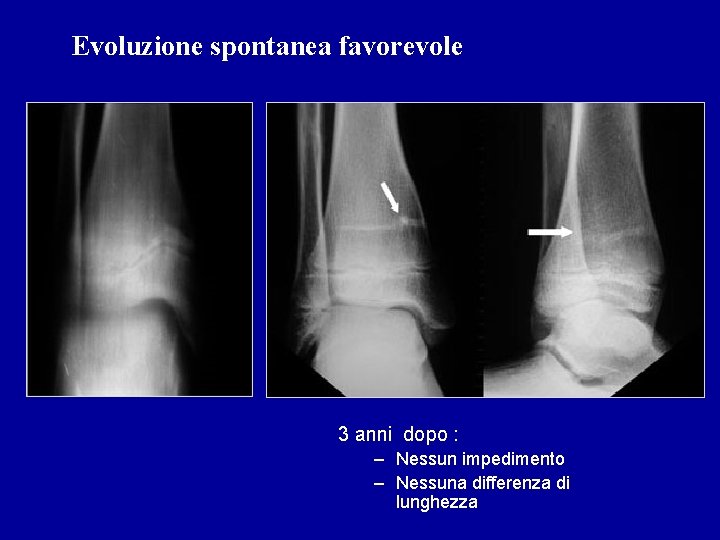 Evoluzione spontanea favorevole 3 anni dopo : – Nessun impedimento – Nessuna differenza di