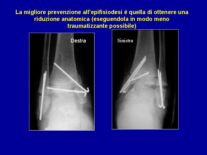 La migliore prevenzione all’epifisiodesi è quella di ottenere una riduzione anatomica (eseguendola in modo