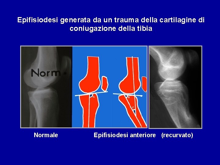 Epifisiodesi generata da un trauma della cartilagine di coniugazione della tibia Normale Epifisiodesi anteriore