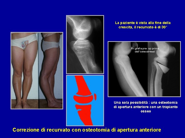 La paziente è vista alla fine della crescita, il recurvato è di 30° Rx