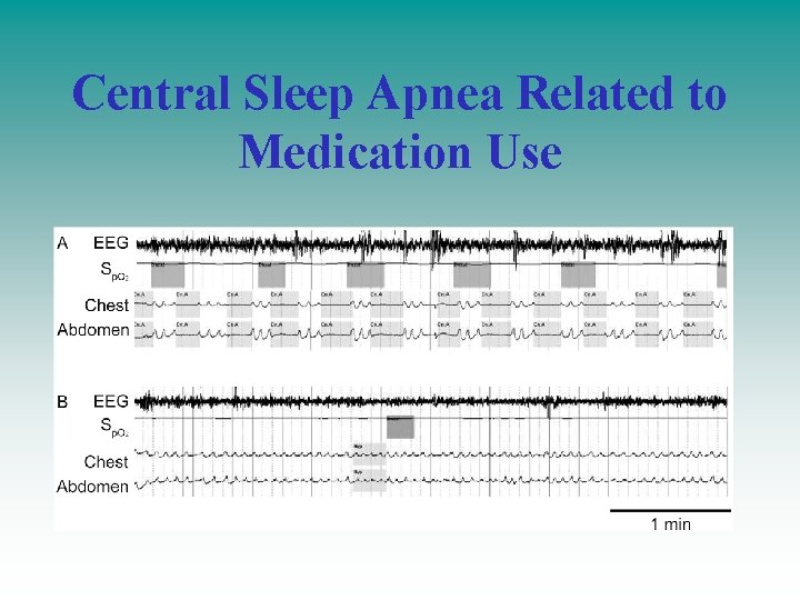 Central Sleep Apnea Related to Medication Use 