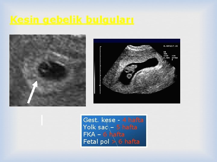 Kesin gebelik bulguları Gest. kese - 4 hafta Yolk sac – 5 hafta FKA