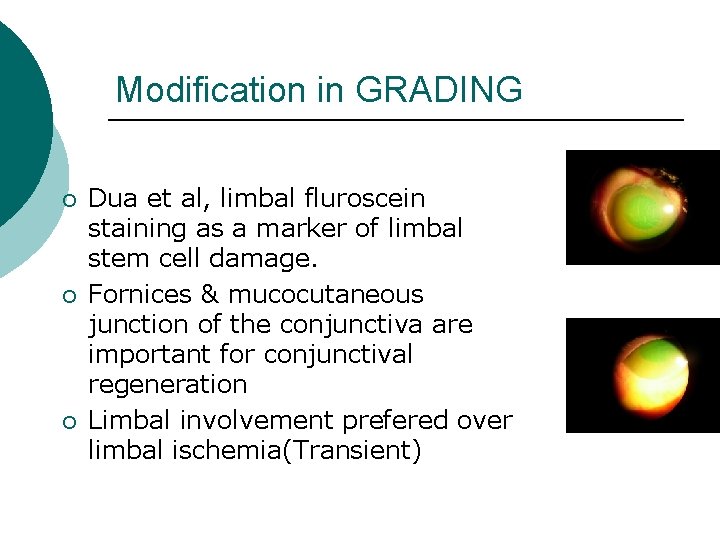 Modification in GRADING ¡ ¡ ¡ Dua et al, limbal fluroscein staining as a