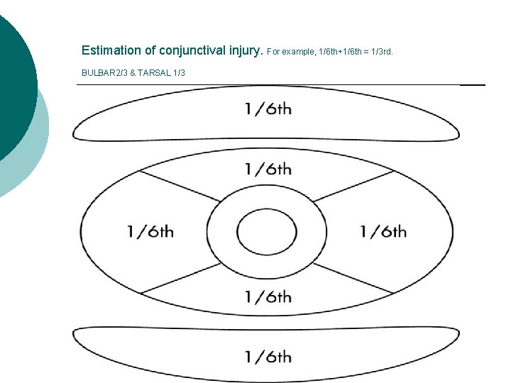 Estimation of conjunctival injury. For example, 1/6 th+1/6 th = 1/3 rd. BULBAR 2/3