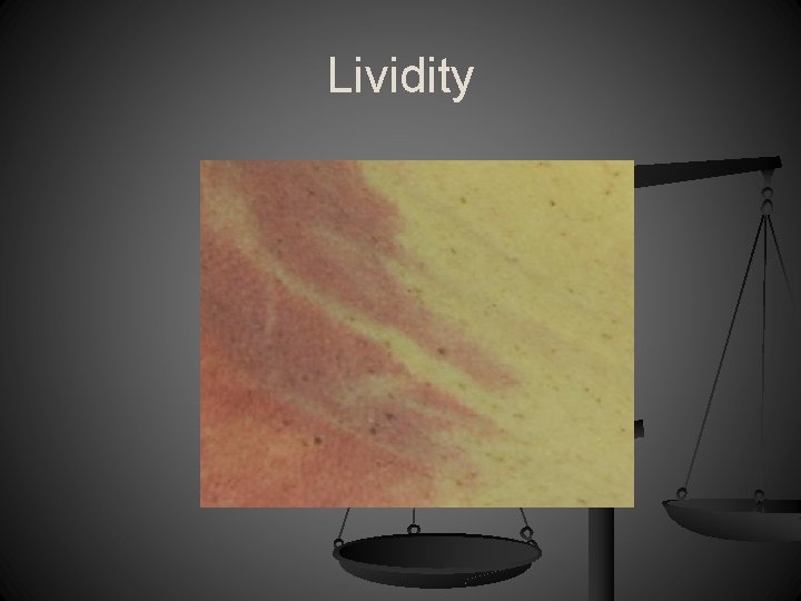 Lividity 