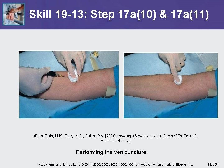 Skill 19 -13: Step 17 a(10) & 17 a(11) (From Elkin, M. K. ,