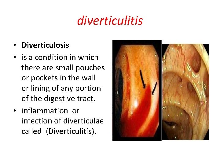 diverticulitis • Diverticulosis • is a condition in which there are small pouches or