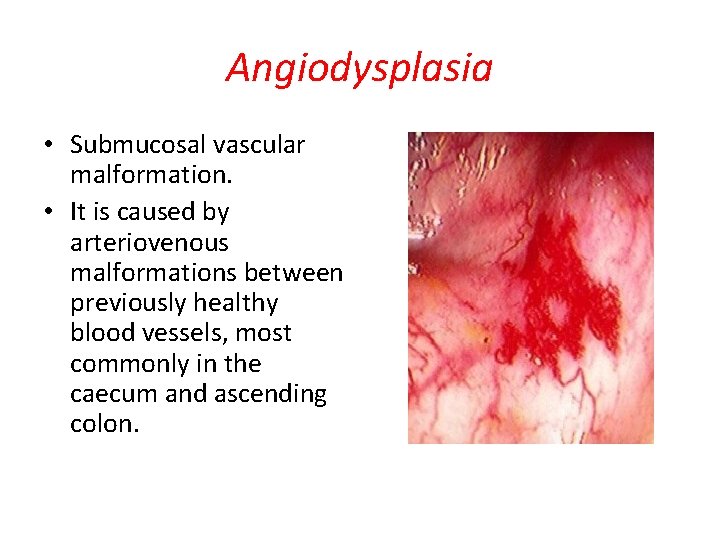 Angiodysplasia • Submucosal vascular malformation. • It is caused by arteriovenous malformations between previously