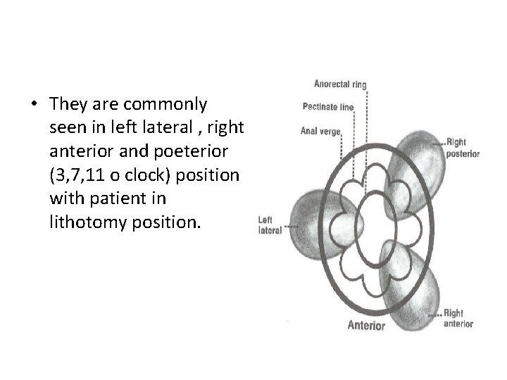  • They are commonly seen in left lateral , right anterior and poeterior