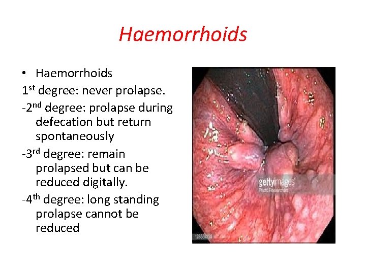 Haemorrhoids • Haemorrhoids 1 st degree: never prolapse. -2 nd degree: prolapse during defecation