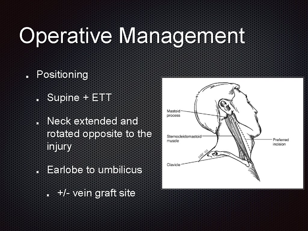 Operative Management Positioning Supine + ETT Neck extended and rotated opposite to the injury