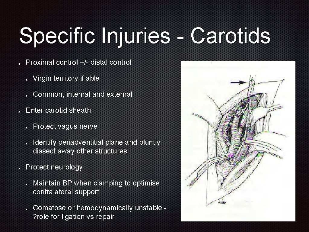 Specific Injuries - Carotids Proximal control +/- distal control Virgin territory if able Common,