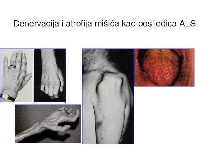 Denervacija i atrofija mišića kao posljedica ALS Incidencija 1/100, 000 Prevalencij a 4 -5/100,