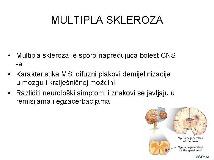 MULTIPLA SKLEROZA • Multipla skleroza je sporo napredujuća bolest CNS -a • Karakteristika MS: