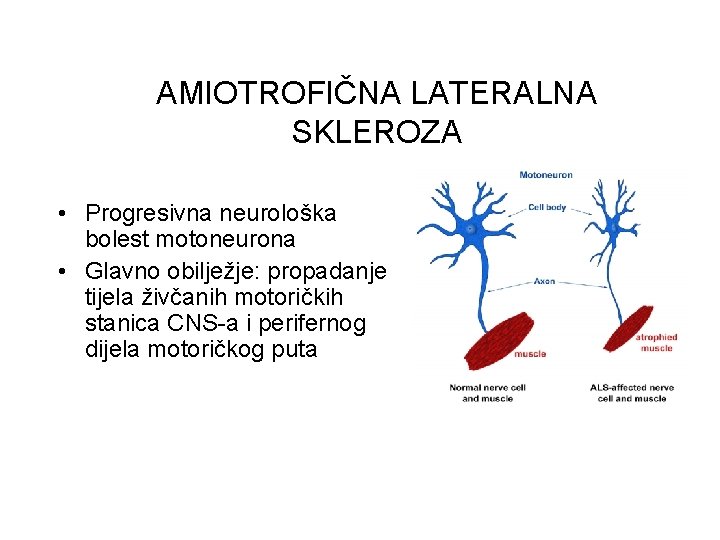 AMIOTROFIČNA LATERALNA SKLEROZA • Progresivna neurološka bolest motoneurona • Glavno obilježje: propadanje tijela živčanih