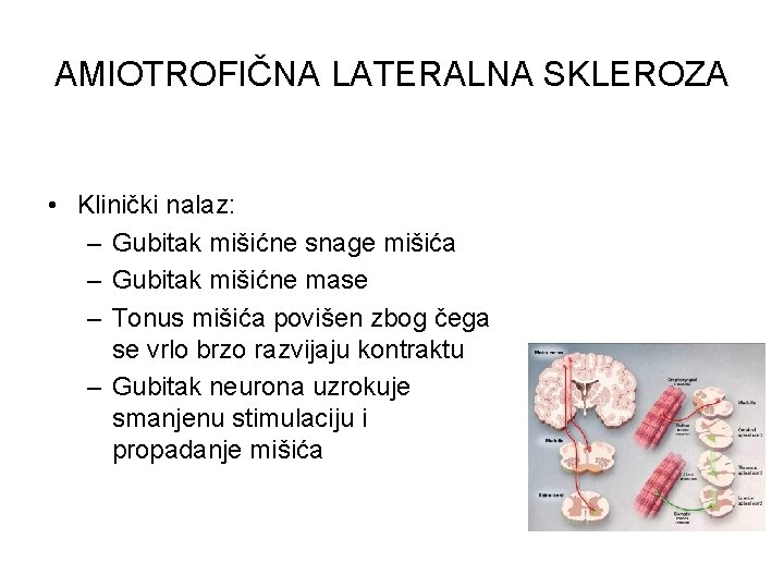 AMIOTROFIČNA LATERALNA SKLEROZA • Klinički nalaz: – Gubitak mišićne snage mišića – Gubitak mišićne