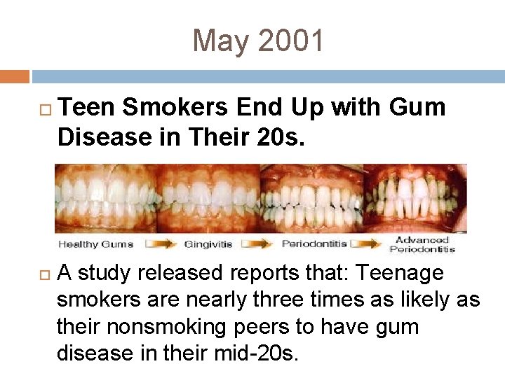 May 2001 Teen Smokers End Up with Gum Disease in Their 20 s. A