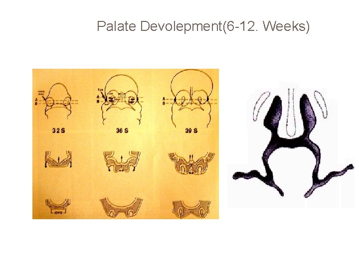 Palate Devolepment(6 -12. Weeks) 