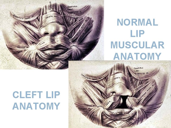 NORMAL LIP MUSCULAR ANATOMY CLEFT LIP ANATOMY 