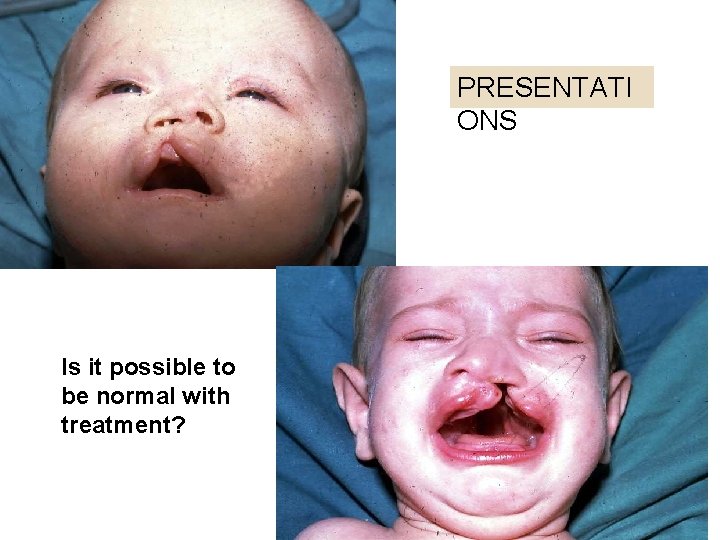 PRESENTATI ONS Is it possible to be normal with treatment? 