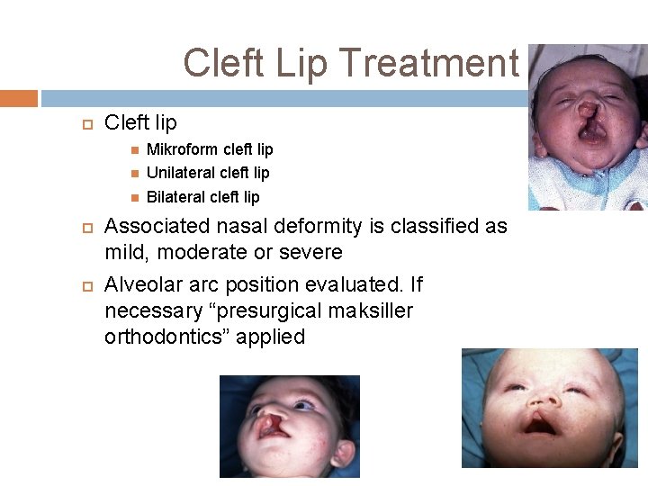 Cleft Lip Treatment Cleft lip Mikroform cleft lip Unilateral cleft lip Bilateral cleft lip