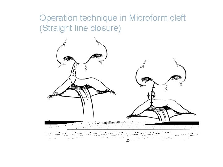 Operation technique in Microform cleft (Straight line closure) 