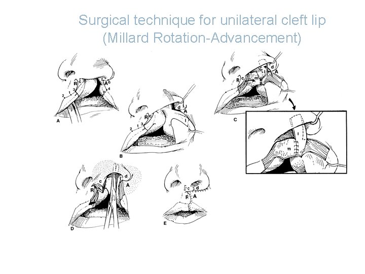 Surgical technique for unilateral cleft lip (Millard Rotation-Advancement) 