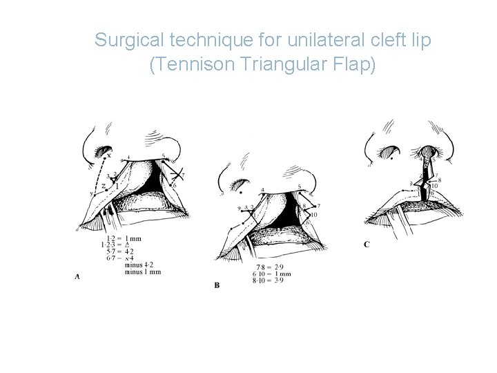 Surgical technique for unilateral cleft lip (Tennison Triangular Flap) 