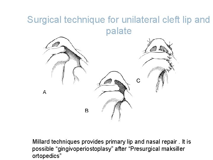 Surgical technique for unilateral cleft lip and palate Millard techniques provides primary lip and