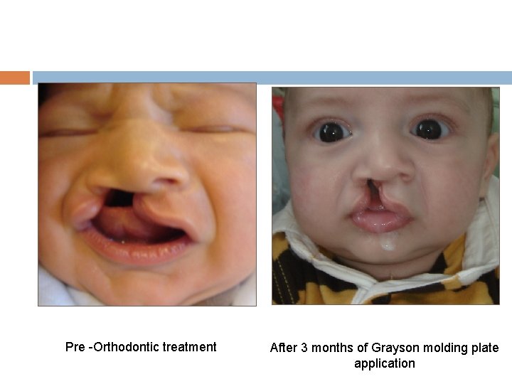 Pre -Orthodontic treatment After 3 months of Grayson molding plate application 