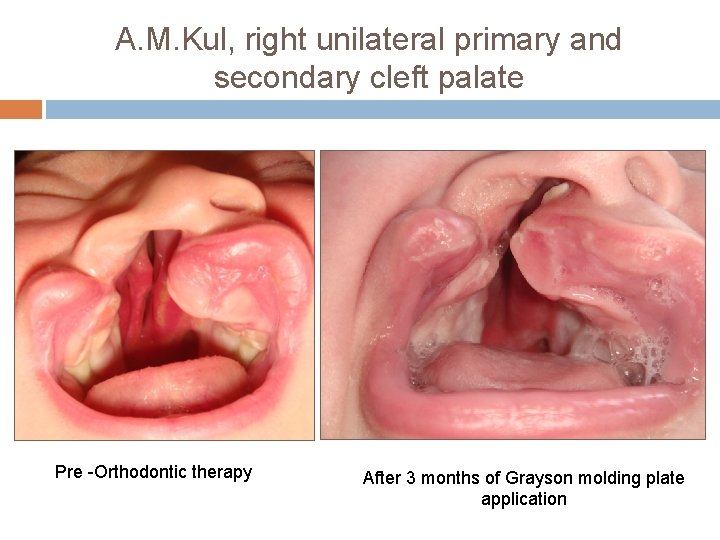 A. M. Kul, right unilateral primary and secondary cleft palate Pre -Orthodontic therapy After