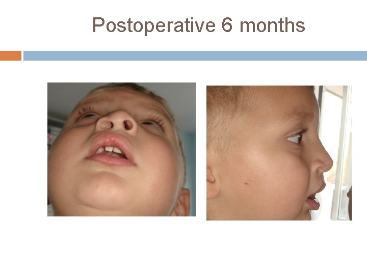 Postoperative 6 months 