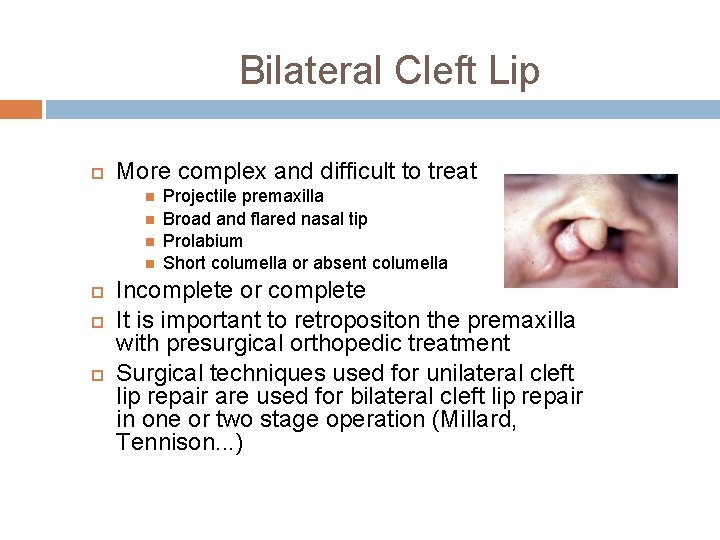 Bilateral Cleft Lip More complex and difficult to treat Projectile premaxilla Broad and flared