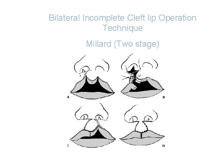 Bilateral Incomplete Cleft lip Operation Technique Millard (Two stage) 