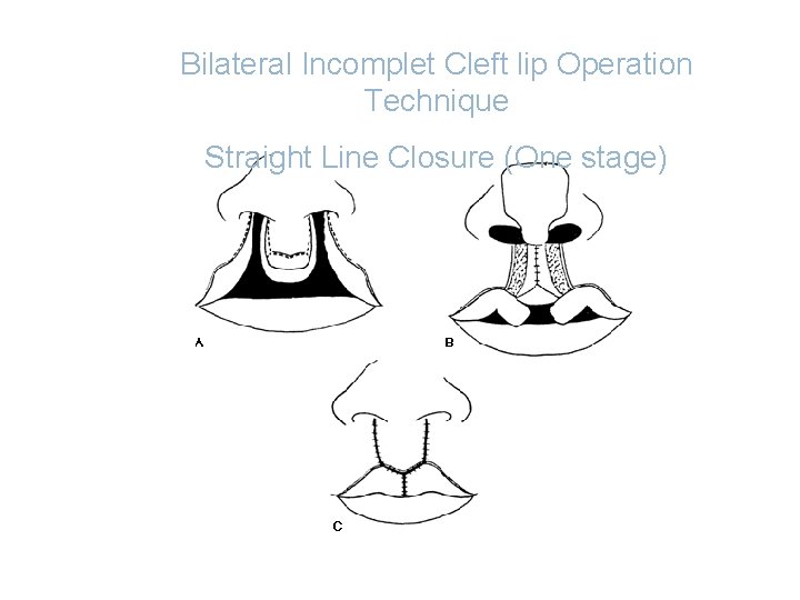 Bilateral Incomplet Cleft lip Operation Technique Straight Line Closure (One stage) 