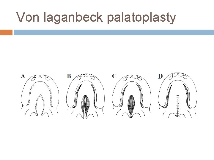 Von laganbeck palatoplasty 