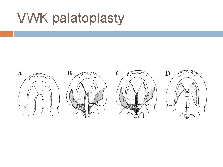 VWK palatoplasty 