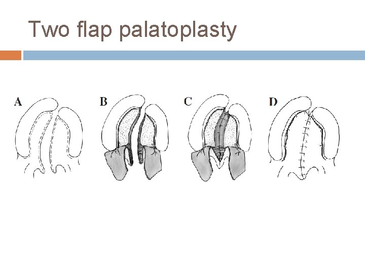 Two flap palatoplasty 