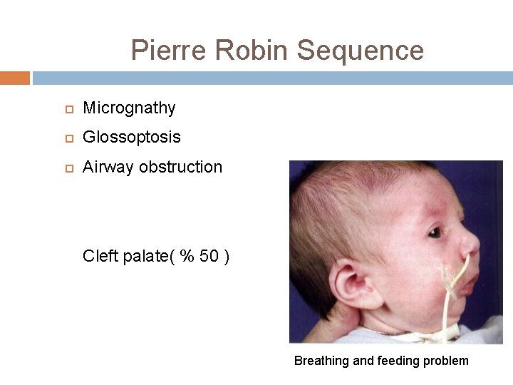 Pierre Robin Sequence Micrognathy Glossoptosis Airway obstruction Cleft palate( % 50 ) Breathing and