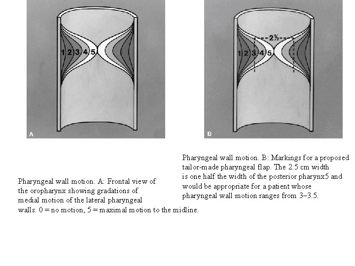 Pharyngeal wall motion. B: Markings for a proposed tailor-made pharyngeal flap. The 2. 5