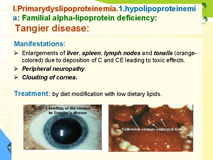 I. Primarydyslipoproteinemia. 1. hypolipoproteinemi a: Familial alpha-lipoprotein deficiency: Tangier disease: Manifestations: Ø Enlargements of