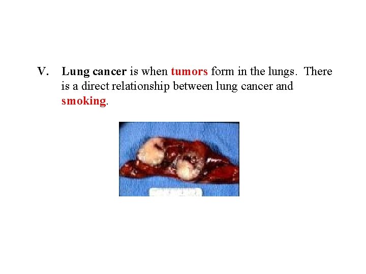 V. Lung cancer is when tumors form in the lungs. There is a direct
