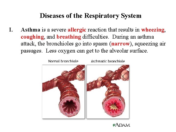 Diseases of the Respiratory System I. Asthma is a severe allergic reaction that results