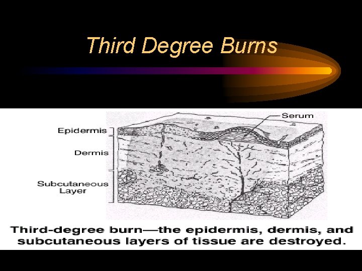 Third Degree Burns Third Degree Burns