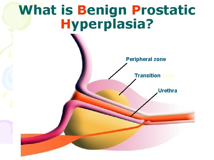 What is Benign Prostatic Hyperplasia? Peripheral zone Transition zone Urethra 28 