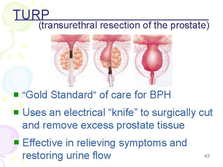 TURP (transurethral resection of the prostate) n “Gold Standard” of care for BPH n