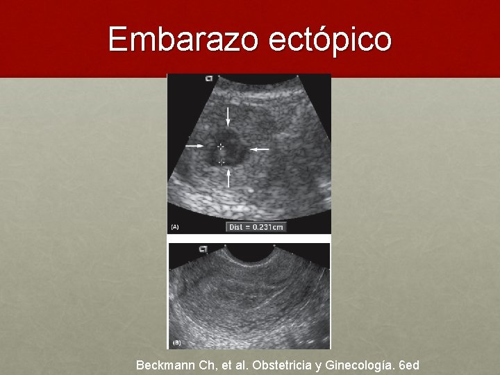 Embarazo ectópico Beckmann Ch, et al. Obstetricia y Ginecología. 6 ed 