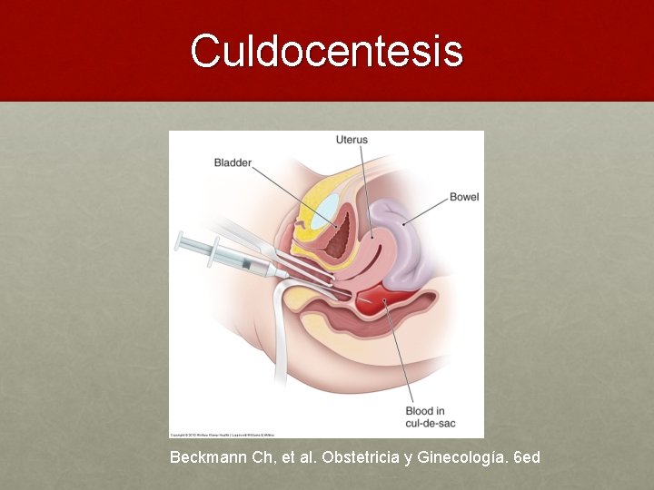 Culdocentesis Beckmann Ch, et al. Obstetricia y Ginecología. 6 ed 